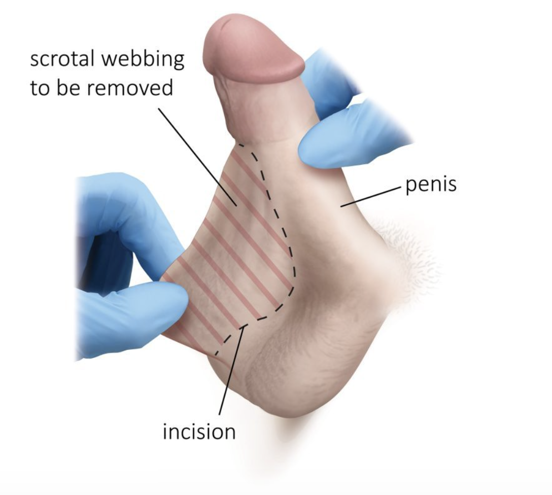 Medical illustration showing scrotal webbing to be removed and incision location for ventral phalloplasty
