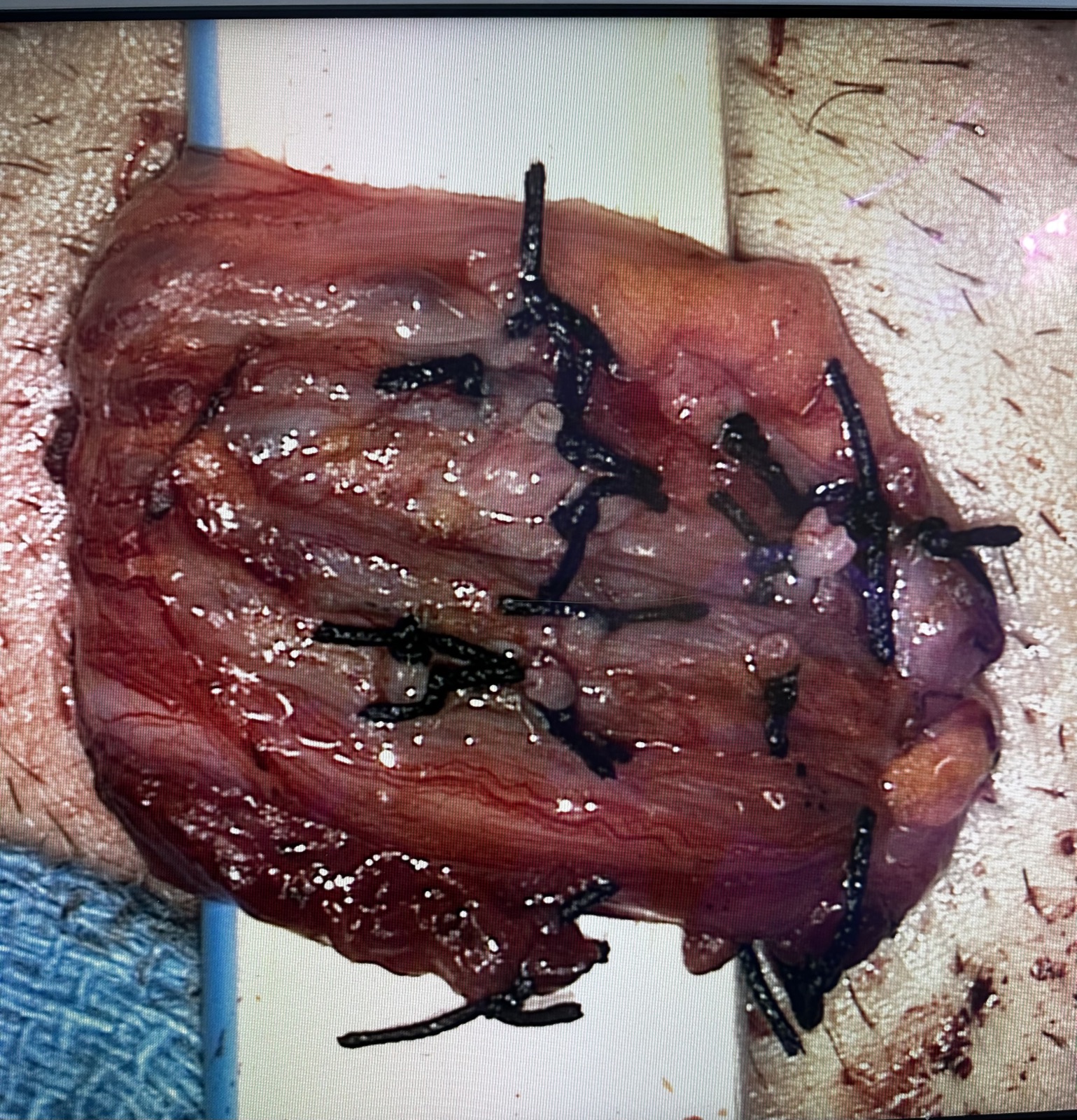 Microsurgical varicocelectomy — intraoperative view