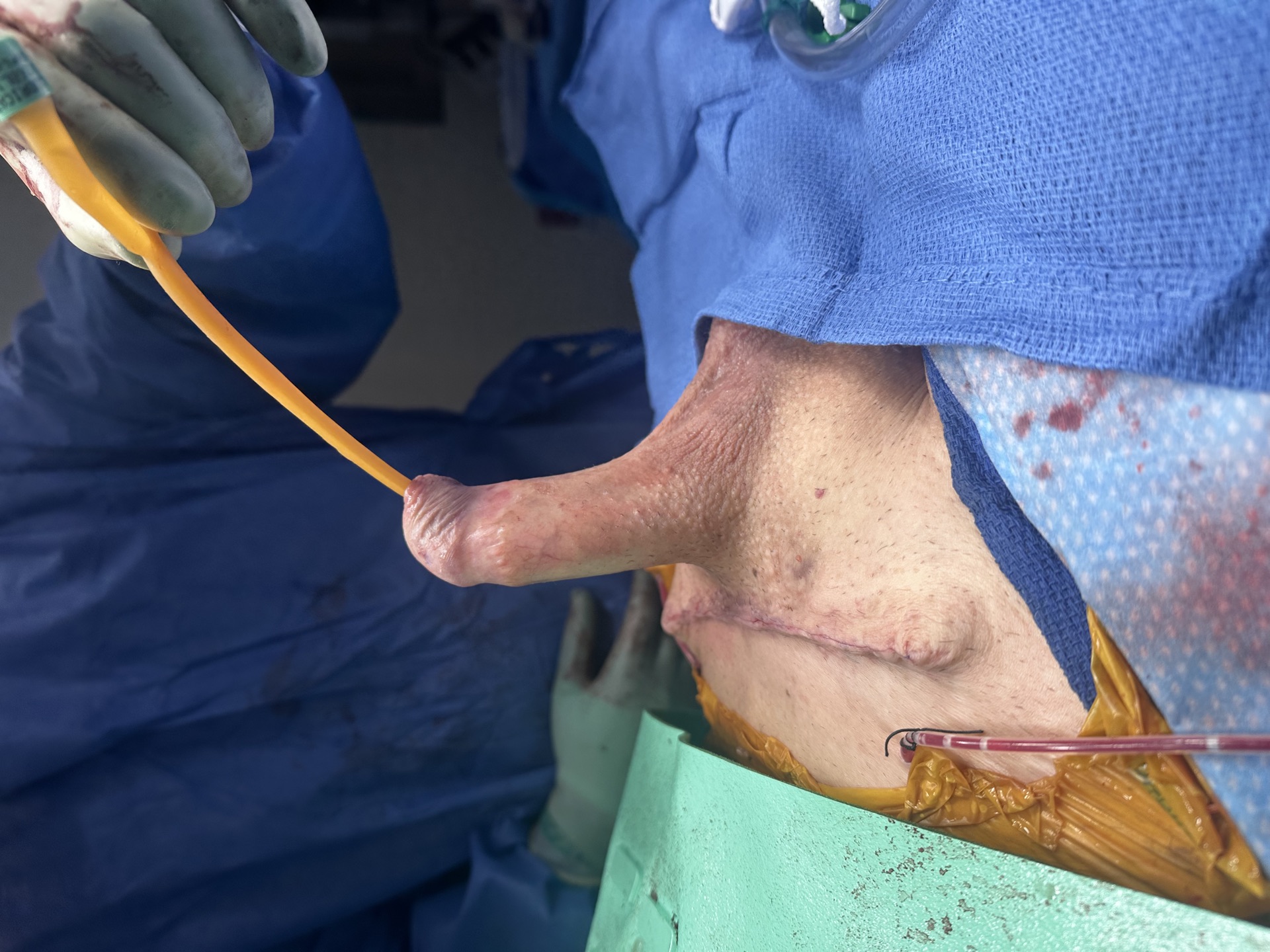 After infrapubic lipectomy with penile implant