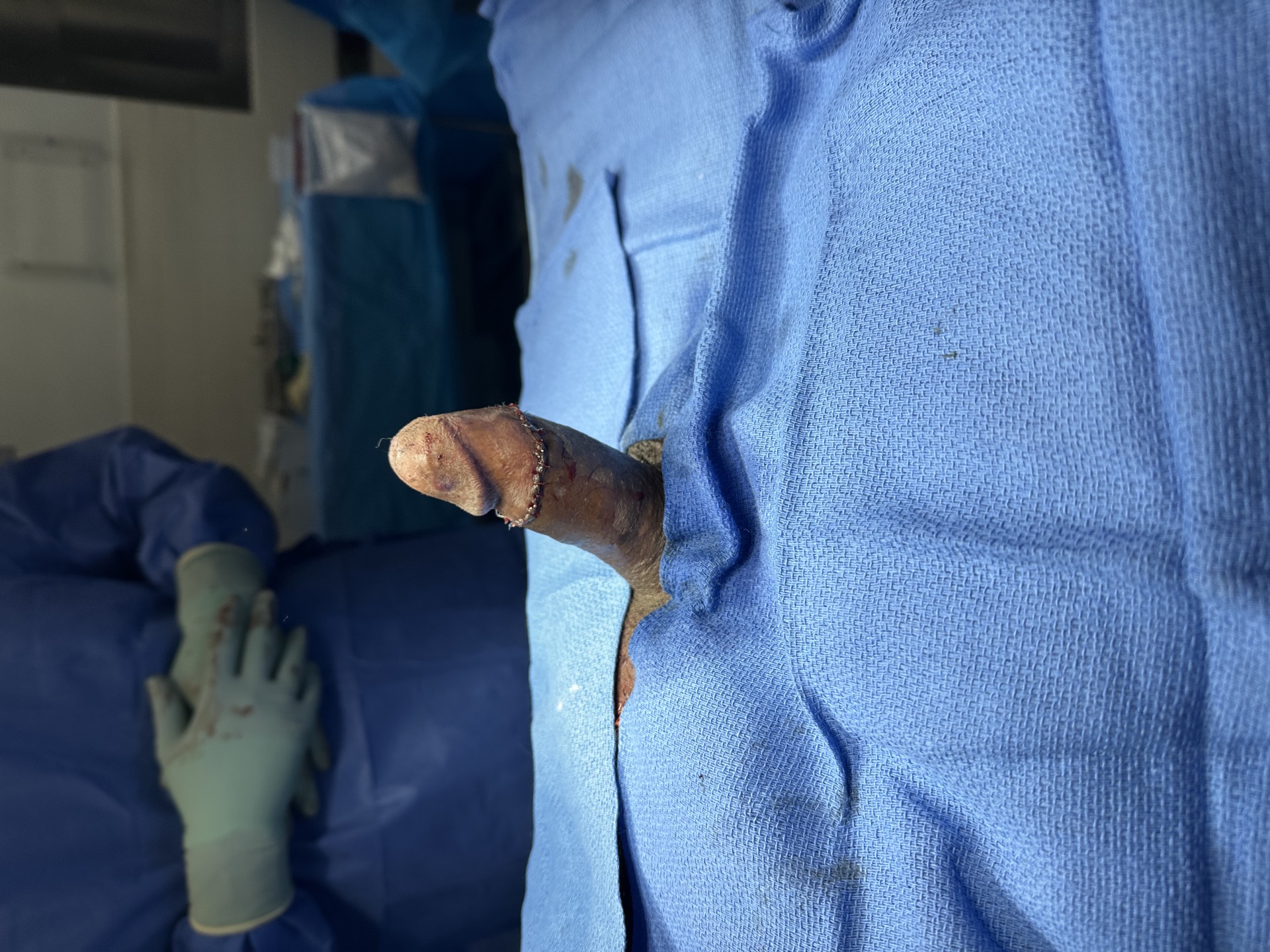After single-incision IPP with PIG