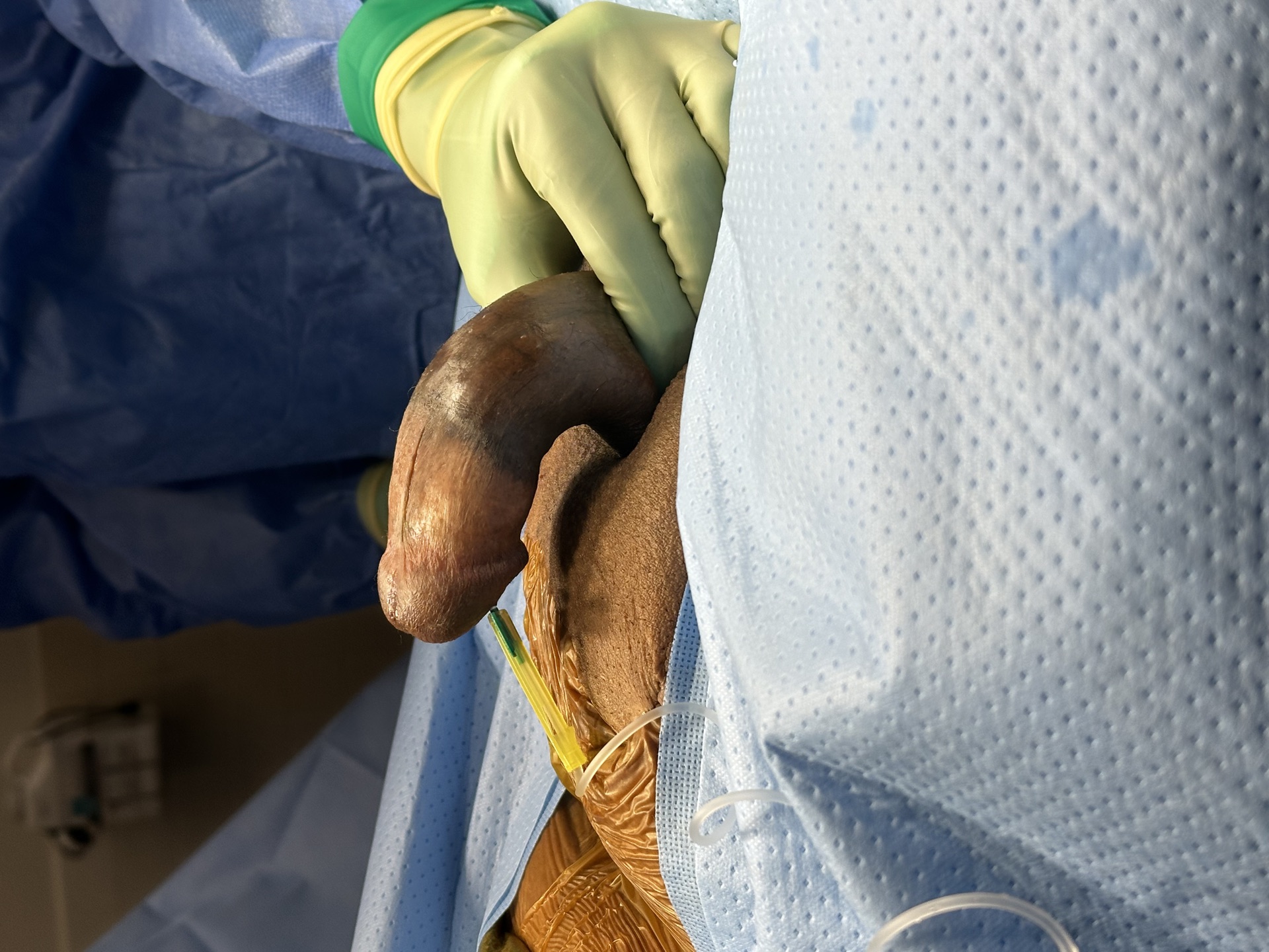 Before single-incision IPP with PIG