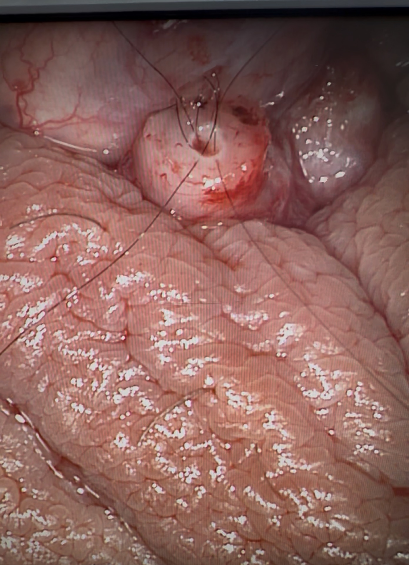 Vasoepididymostomy — after reconstruction