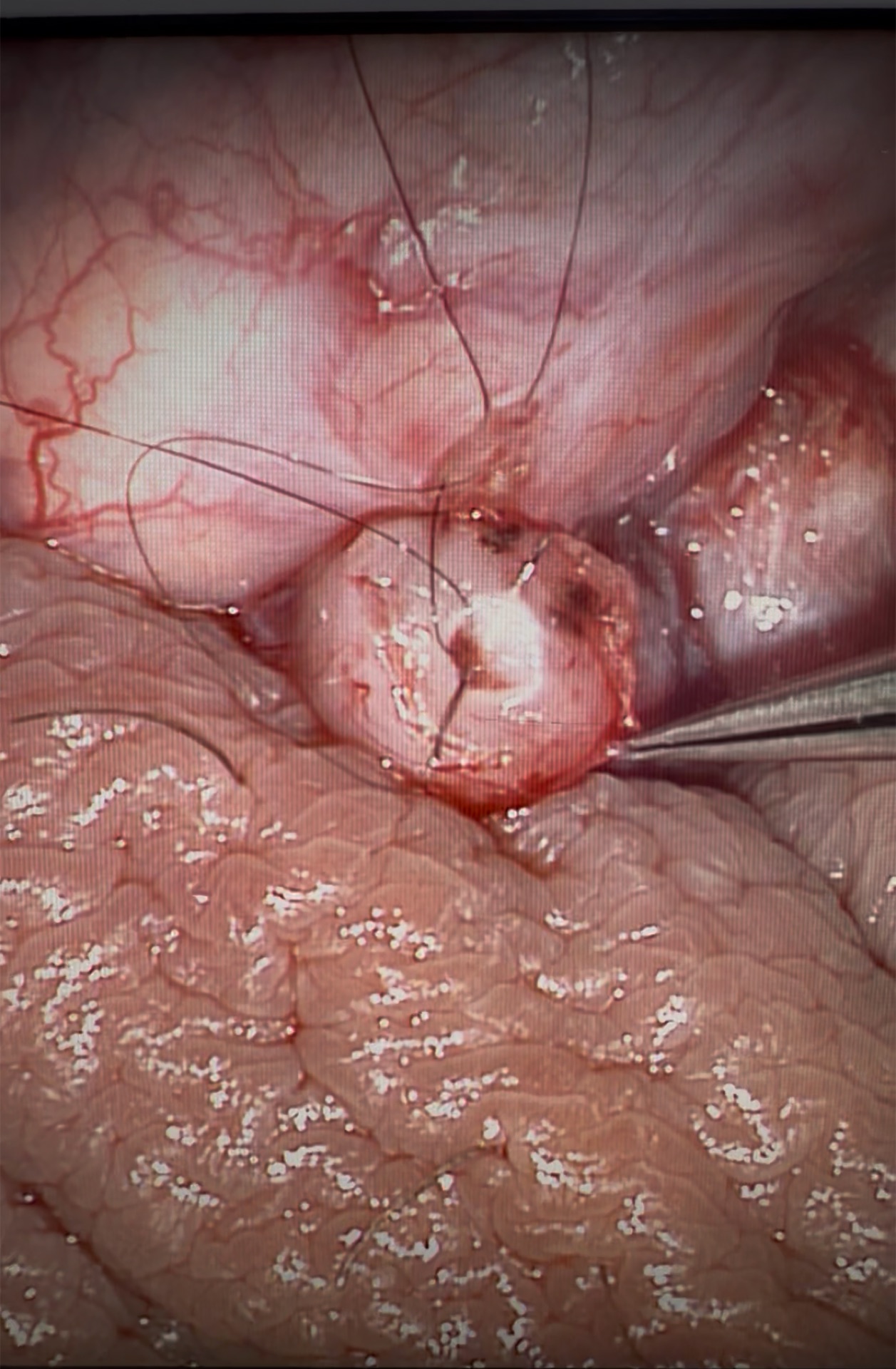 Vasoepididymostomy — before reconstruction